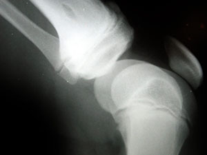knee-arthritis-01